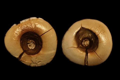 antiche otturazioni dentali